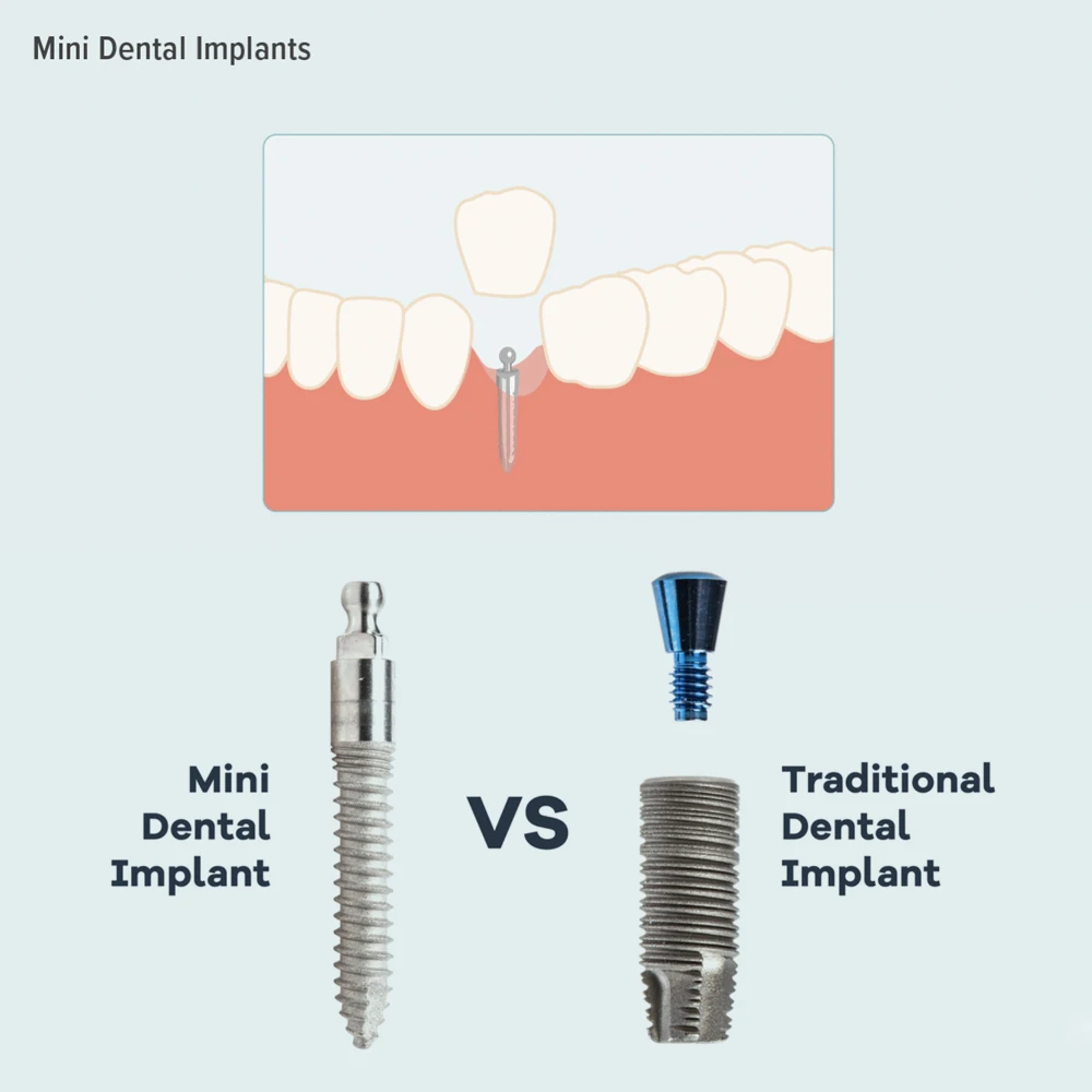 MDLMOR10Z MDLORZ Replacement O Ring Kit, for Intralock Mini Implant Metal Housing Maintenance