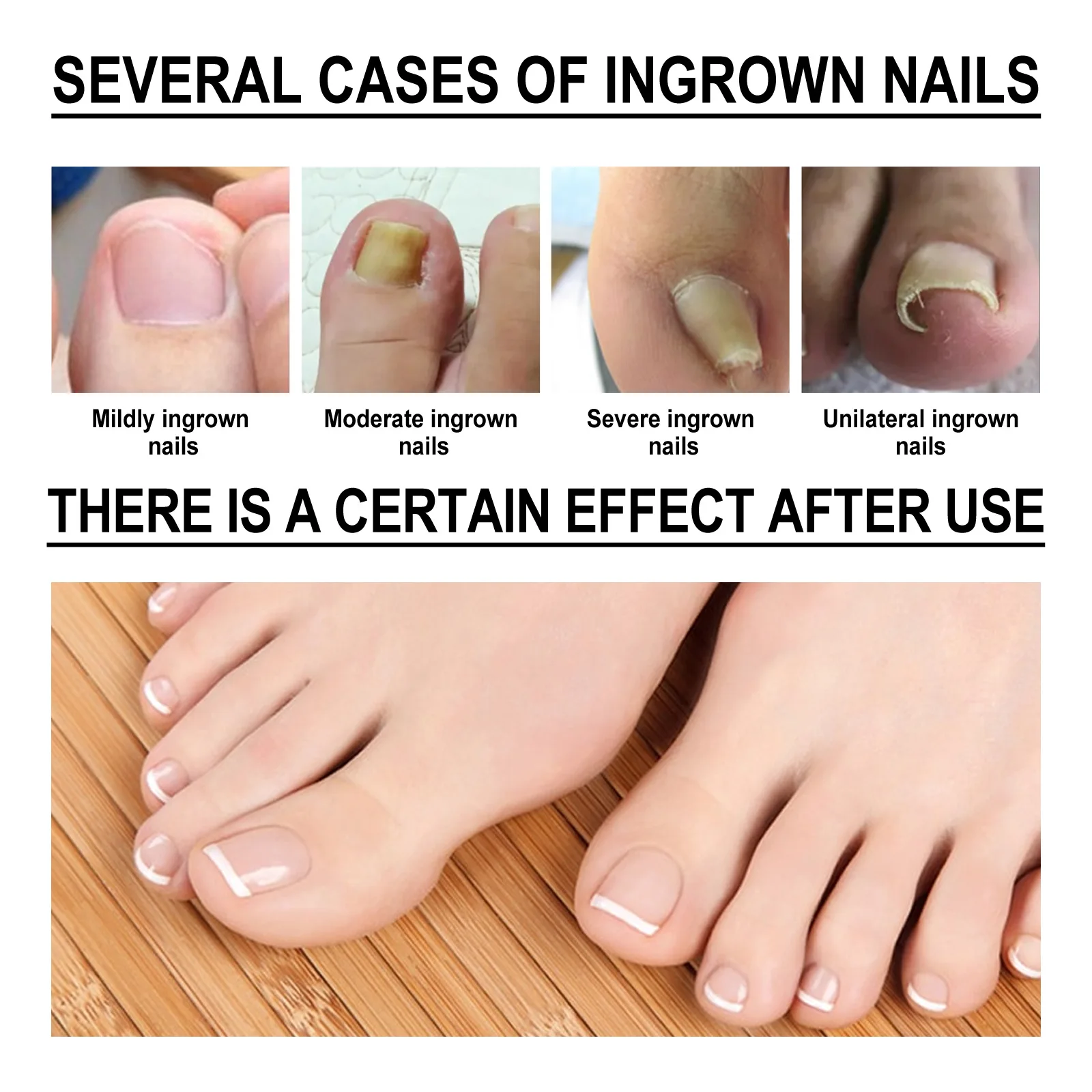 Ingrown Toenail Treatment Liquid Effective Serum Nail Correction Recover Oil Pain Reliever Nail Softener Repair Foot Nail Care