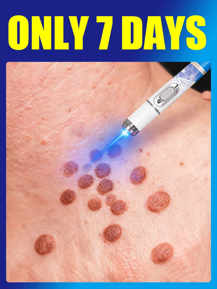 Outil Wart Blue Light