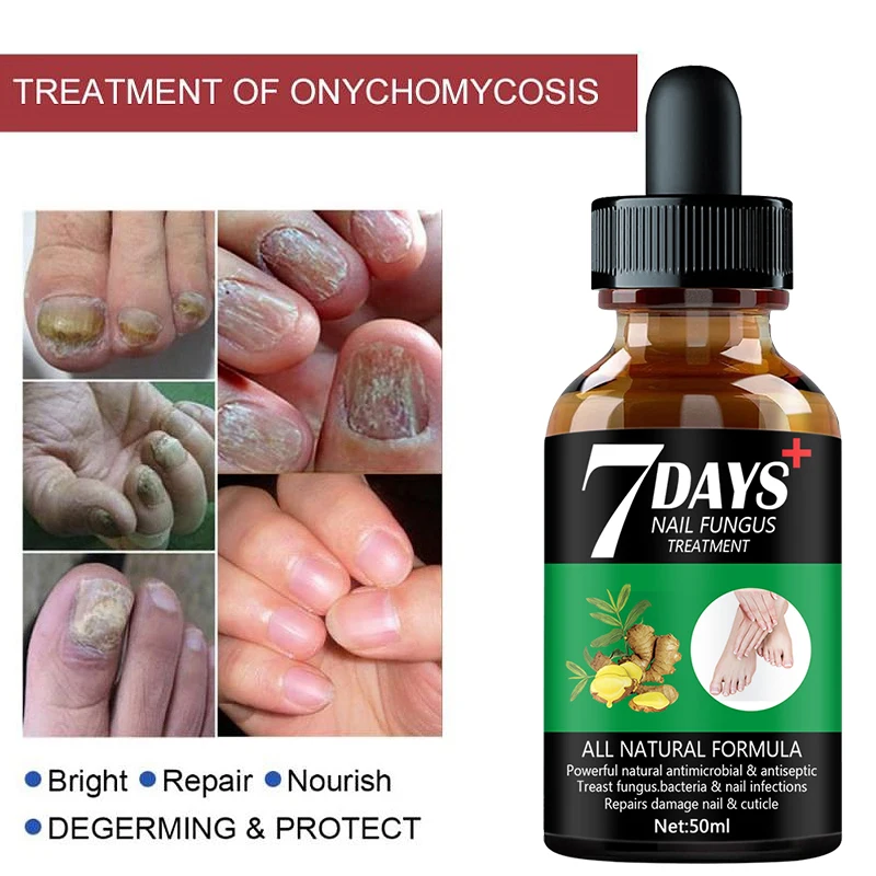 7 Dagen Reparatie Nagel Schimmel Behandelingen Essence Voetverzorging Serum Teen Nagels Schimmelverwijdering Gel Anti-Infectie Onychomycosis(50Ml)