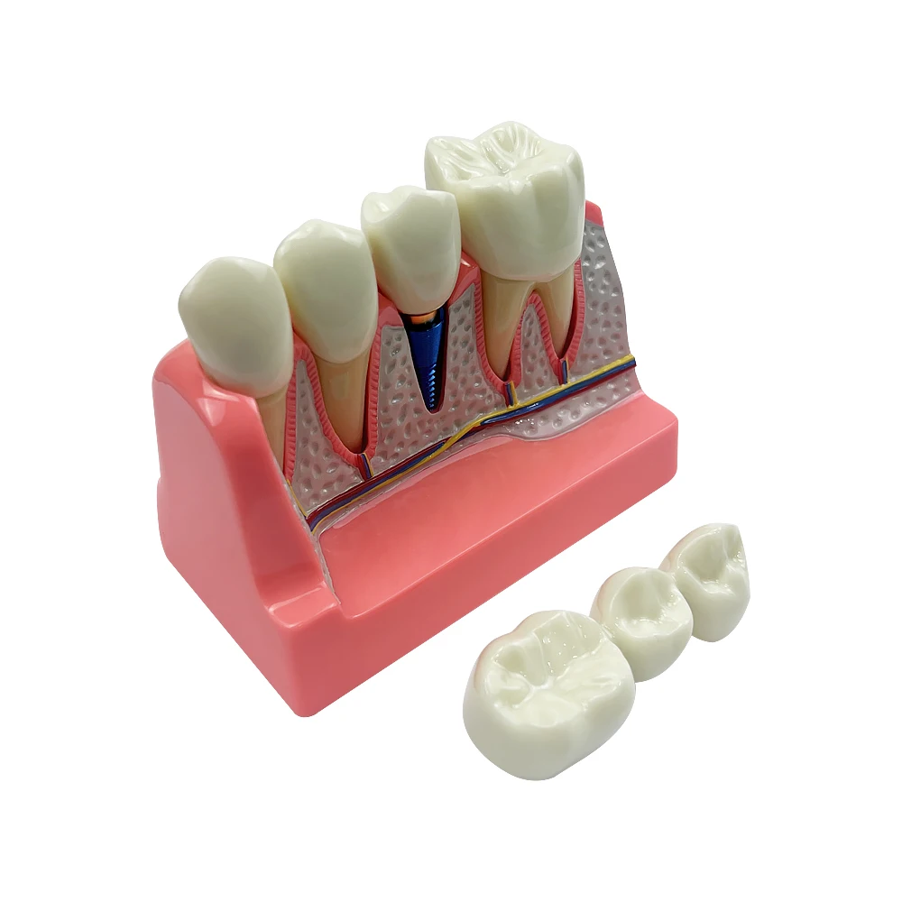 4 Times Implant Model Dental Bridges Crown Dental Teaching Model With Removable Teeth Dentistry Dentist Education Study Model