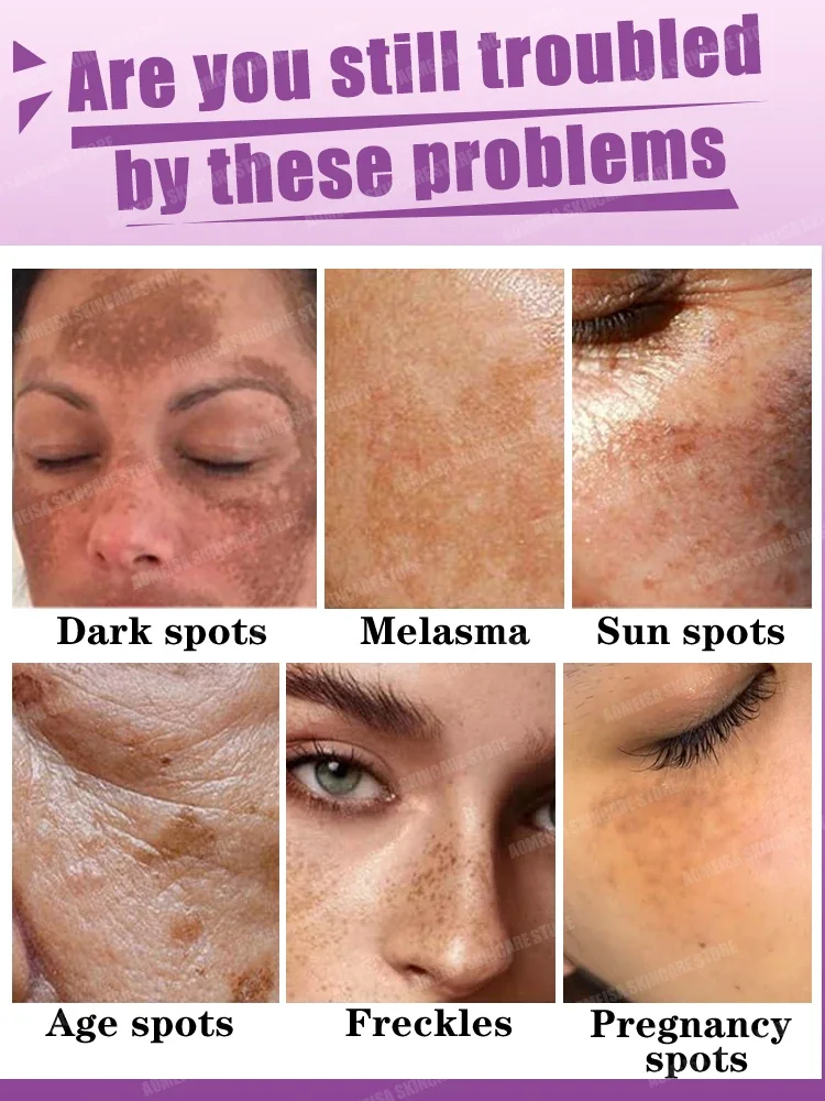 Dark spot Remover For Face ProductsFreckle Melasma Sun Age Spots Deep Removel cream