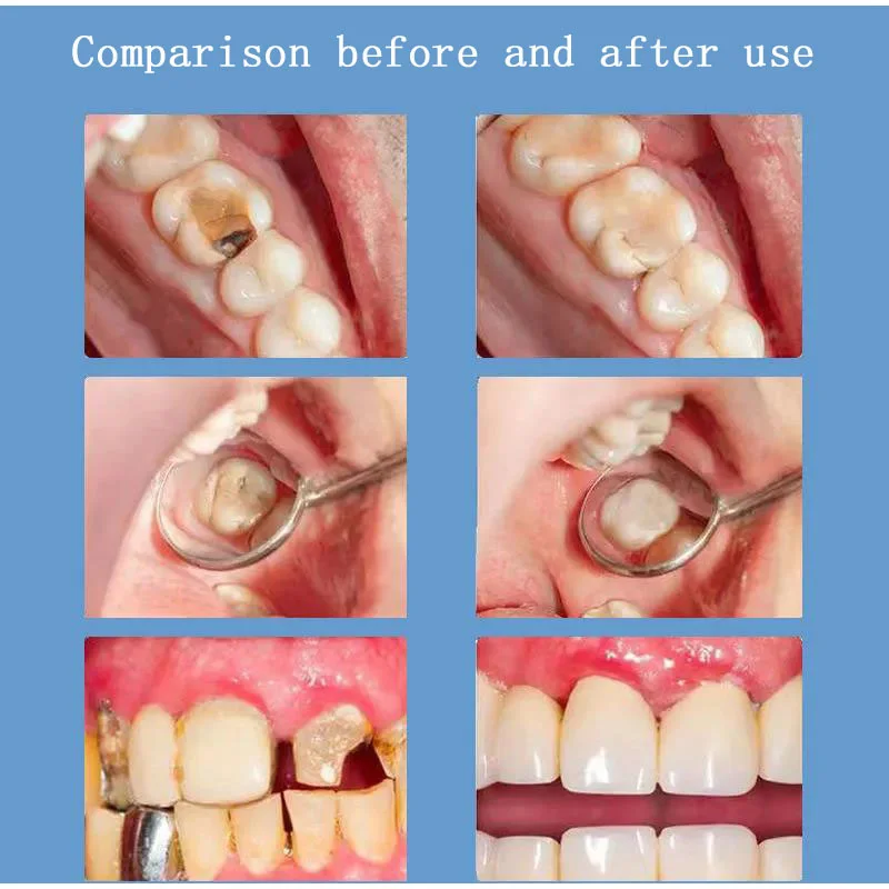 Dentes amarelados branqueamento dentífrico, Reparação de cavidades, Cárie remoção de manchas de placa decadência, Novo, 2023