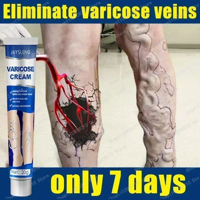 Effective Varicose Vein Relief Eliminate Vasculitis Phlebitis Spider Leg Sooth Relieve Fatigue Natural Herbal Ointment