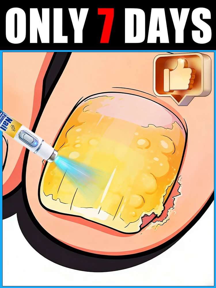 

Advanced Nail Laser Pen 5th Gen, Say Goodbye to Onychomycosis