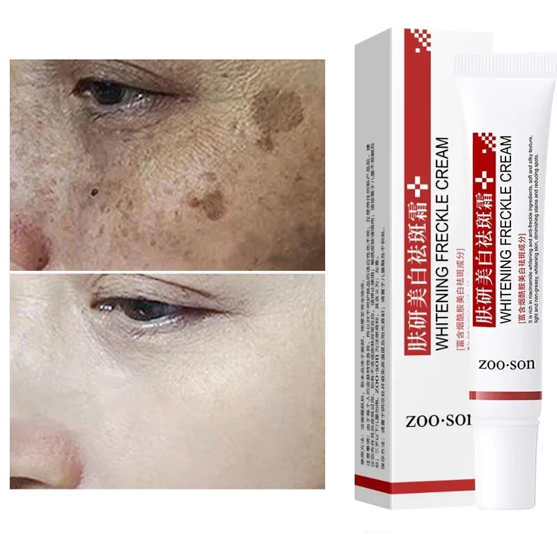 Eficaz Whitening Freckle Cream, Niacinamida, Remova manchas escuras, Anti Freckle, Fade Pigmentation, Cremes de melasma, Skin Care