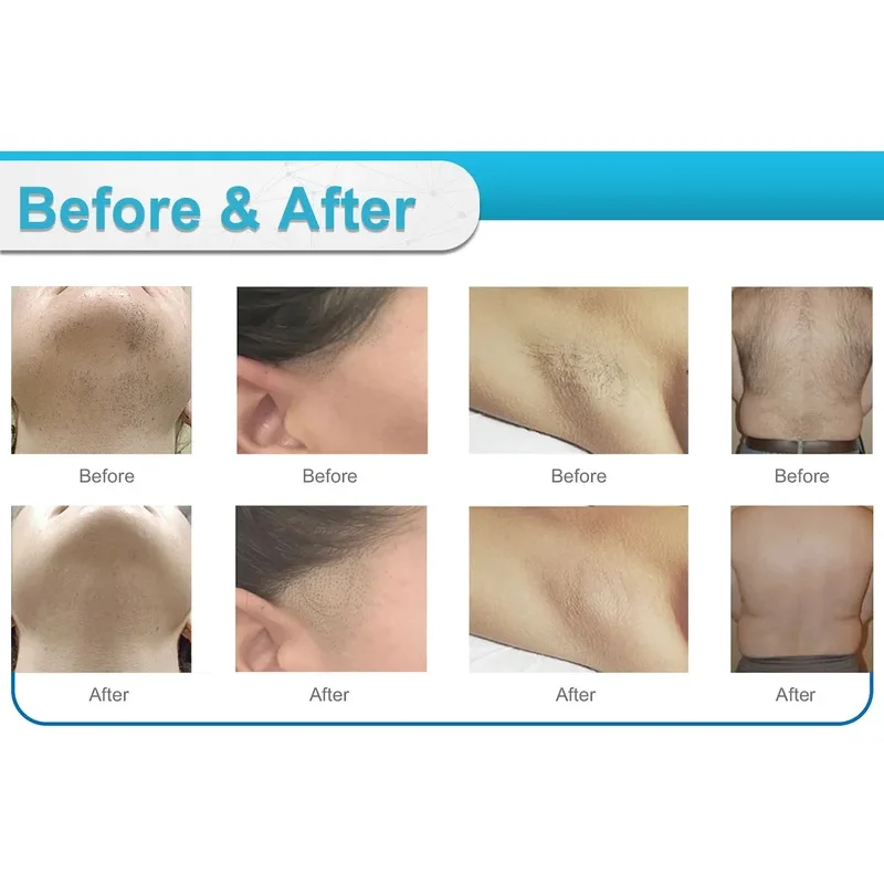 ديود ليزر 755 808 1064nm متعدد الأطوال الموجية آلة إزالة الشعر تبريد الرأس آلة إزالة الشعر بالليزر غير مؤلم إزالة شعر الوجه والجسم #4