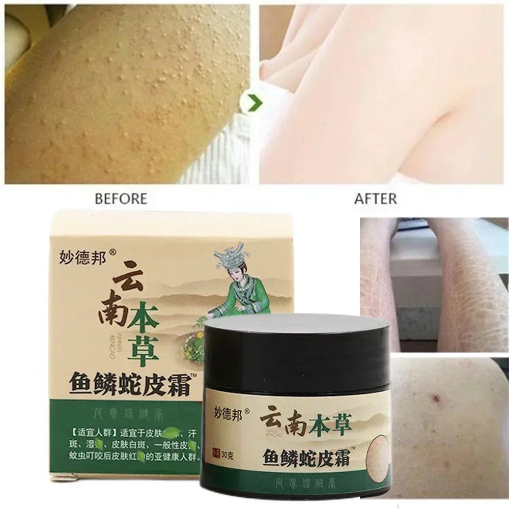 Curing Keratosis Pilaris Chicken Follicle Skin Repair Cream Body Dark Spot Remove Whiten Smooth Moisturize Skincare Body Lotion