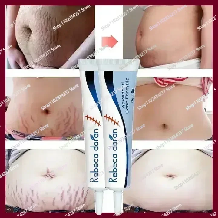 Remover Stretch Mark Permanent Stretch Mark Removerstretch marks New