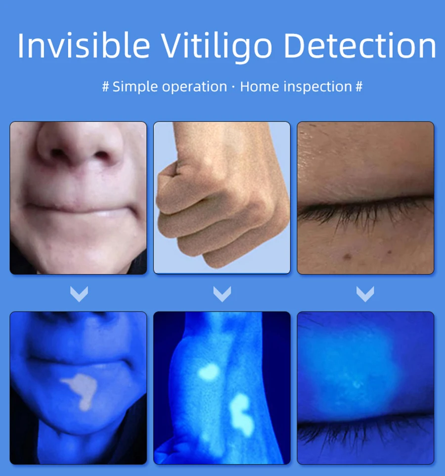 Houten Lamp voor Huidanalysator Vitiligo Testen Onderzoek Vergrotende Analyzer Machine Huiddetectie Ultraviolet Kat Mos Licht