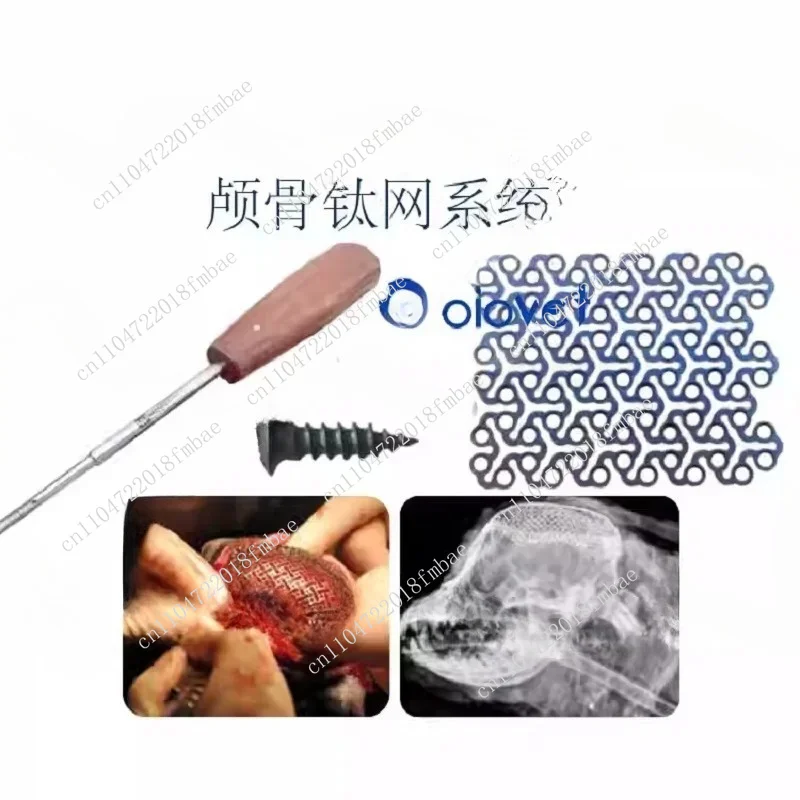 Osteopathic and Maxillofacial Neurosurgery System Cranioplasty with Titanium Mesh Screw Implants
