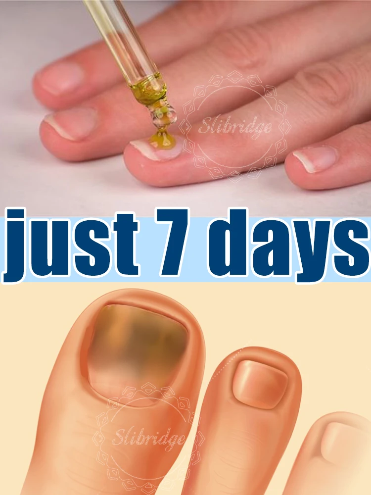 

2025 Toenail Fungus Patch Waterproof Nail Repair Patches Nail Ingrown Correction Sticker Discolored Damaged Nail Foot Care Tool