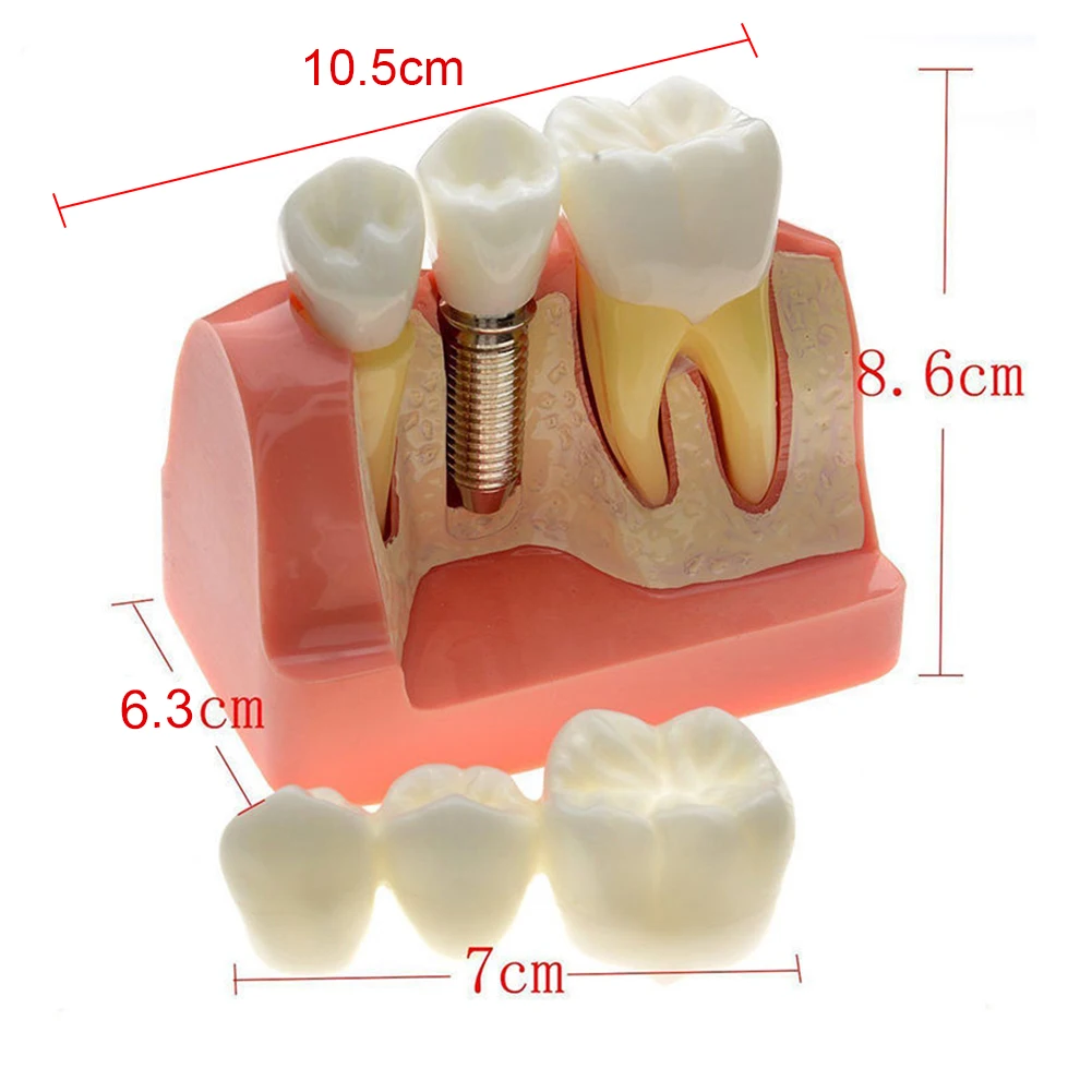 

4 Times Dental Teaching Model Implant Analysis Crown Bridge Demonstration Denture Mold Set Dentist Removable Resin False Teeth