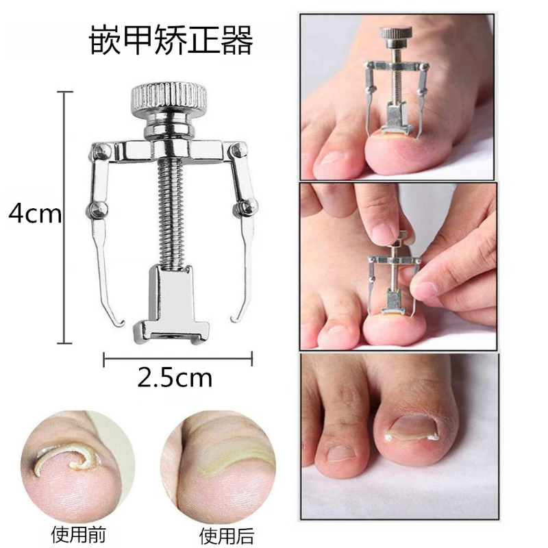 Ingrown Toenail Corrector Straightening Clip Pedicure Foot Nail Care Tools Stainless Steel Pedicure Treatment Onyxis Correction