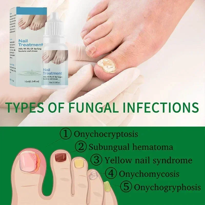 Effective Fungal Nail Treatments Nail Repair Oil Toe Repair Essence Powerful Anti Infection Cream for Fungal Nail Treatment