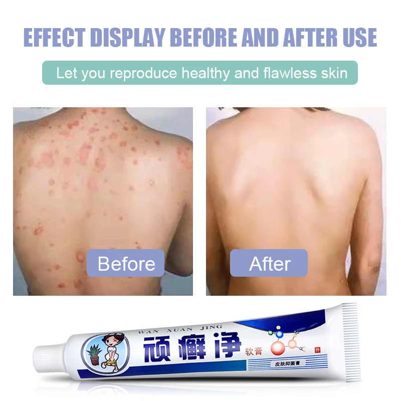 1pcs Skin Psoriasis Cream 100% Original Herbal Plaster Dermatitis Eczematoid Eczema Ointment Treatment Psoriasis Skin Care Cream