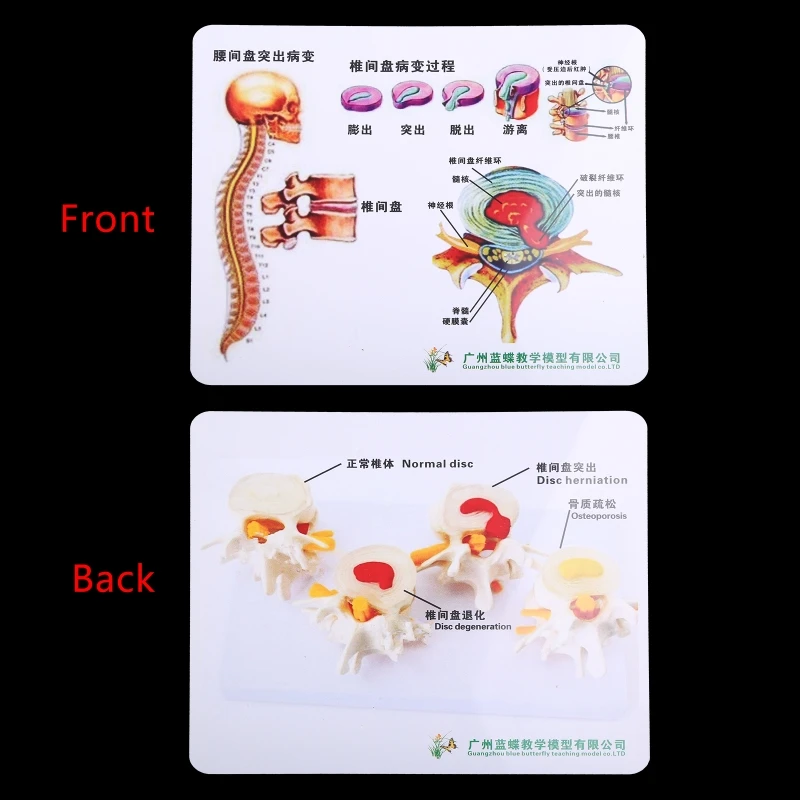 1 Set Human Lumbar Lesion Spine Statue Display Model Medical Teaching Learning