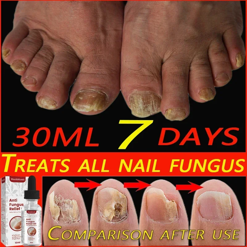 Fast Onychomycosis Fungus Nail Repair