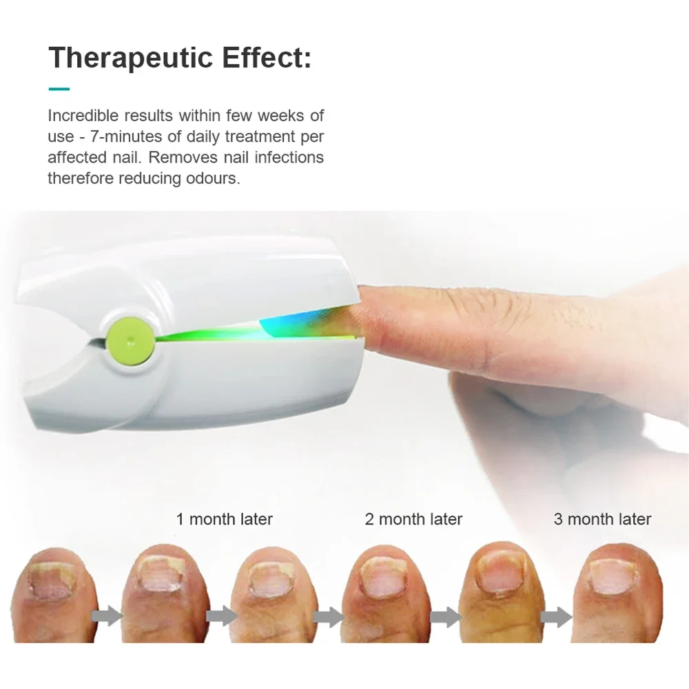 Nail Fungus Laser Assist Tool Professional Nail Fungus Cleaning Laser Device Nail Phototherapy Lamp Effectively Remove Clean