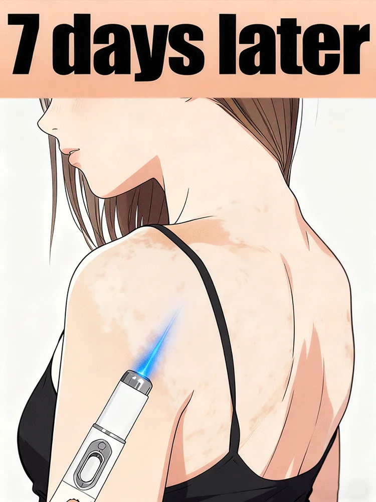 

2025 New Blue Laser care Vitiligo