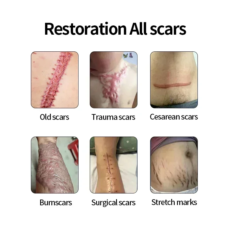 Thailand Scar Removal Cream Repair Trauma Fade Scars Old Scars Keloid Scar Treatment Burn Surgical Crocodile Ointment 15g