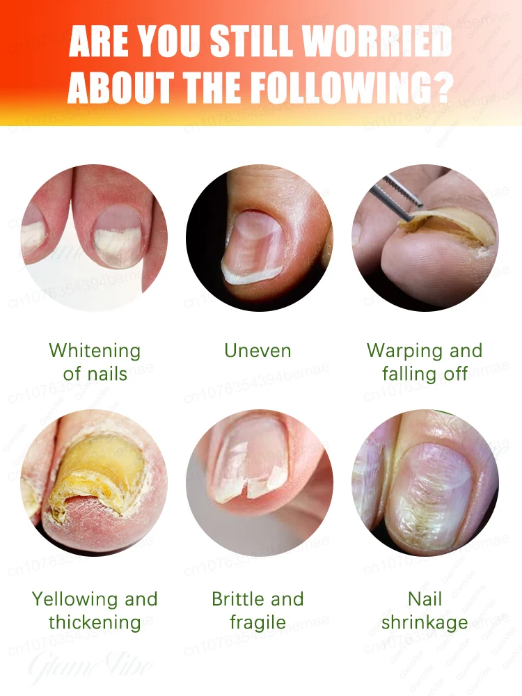Eliminar permanentemente los hongos en las uñas