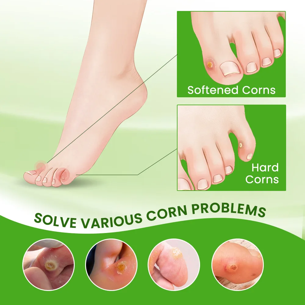 Foot Corn Remover Cream Chicken Eye Skin Infection Treatment Ointment Feet Dead Skin Calluses Removal Tool Health Care 내성발톱