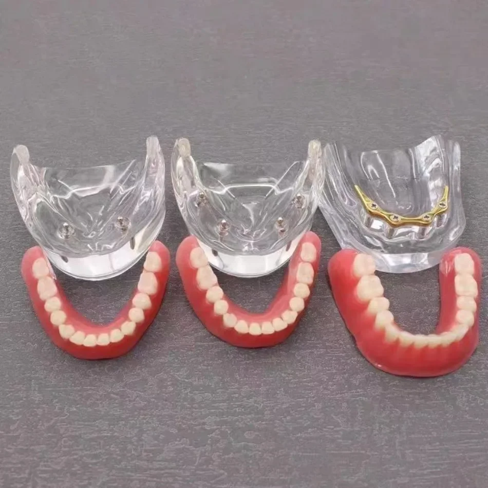 Dental Model: Mandibular Tooth 2-pin and 4-pin Implant Model for Doctor-patient Communication and Display Model