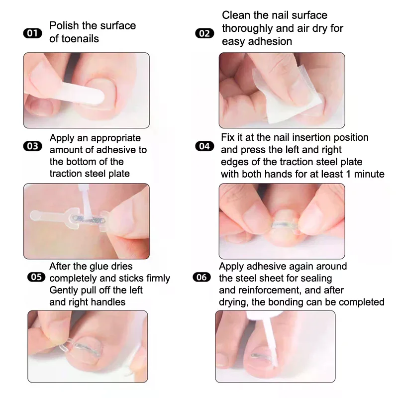 Soins des ongles, Correction des ongles incarnés, traitement des ongles des orteils incarnés, Patch élastique autocollant, Clip de redressage, outil de pédicure