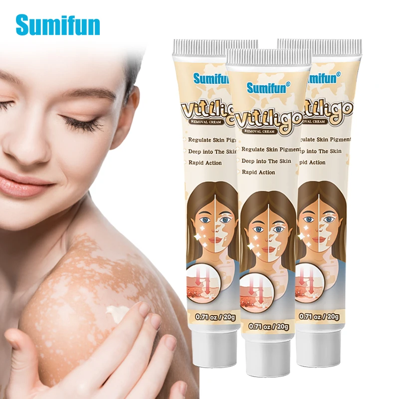 

1-3pcs Vitiligo Treament Cream Antibacterial Creams Psoriasis Localized Vitiligo Ointment White Spot Mycosis Leukoplakia Treat