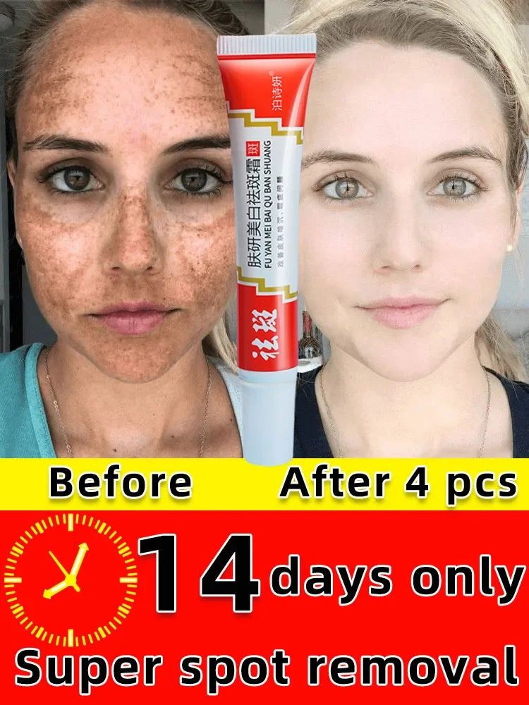 

Freckle Whitening Cream Black Dots Melasma Remover Anti Brown Stain Lighten Pigmentation Moisturizing Korean Skin Care Products