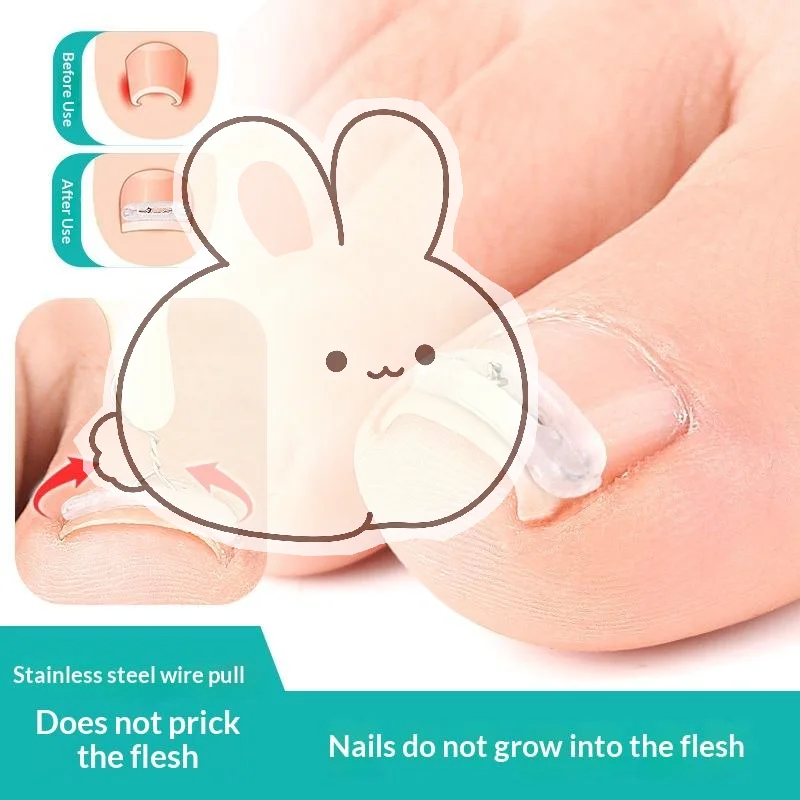Ingrown Toenail Corrector Tool Set Easy to Use Painless Professional Pedicure Kit for Foot Nail Treatment