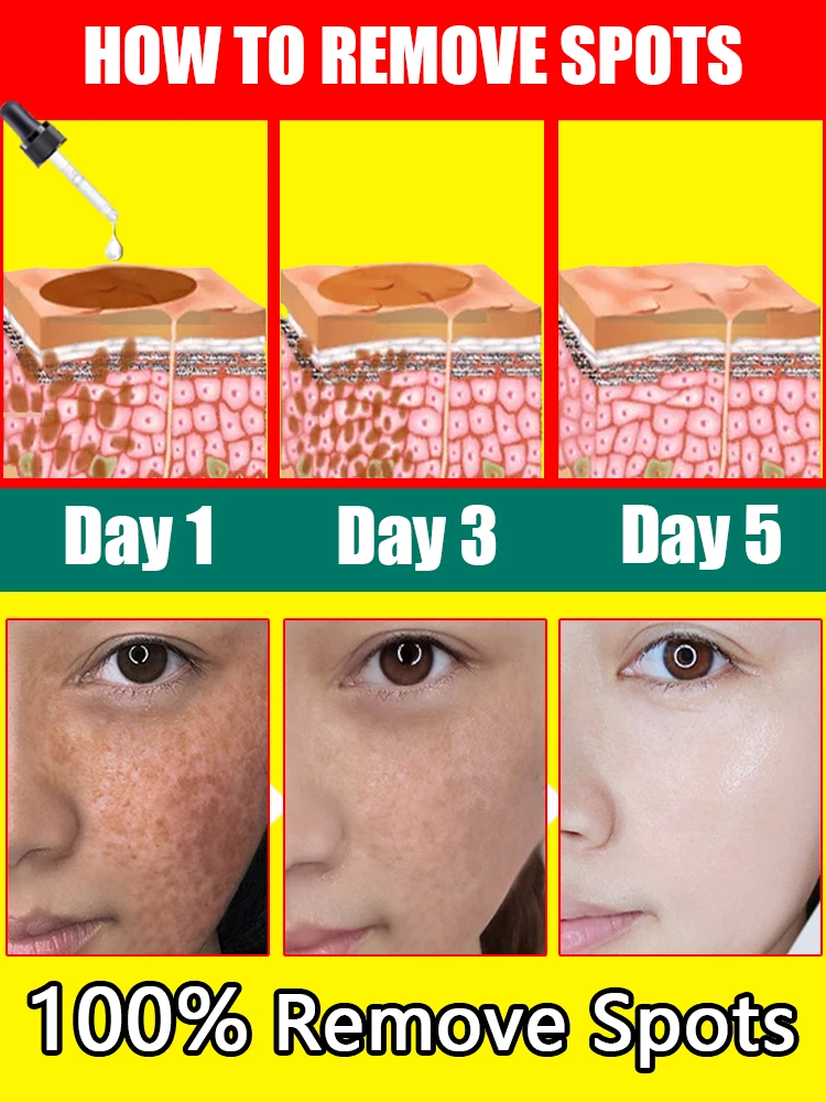 Penghapus bintik-bintik esensi penghilang noda gelap untuk wajah Melasma