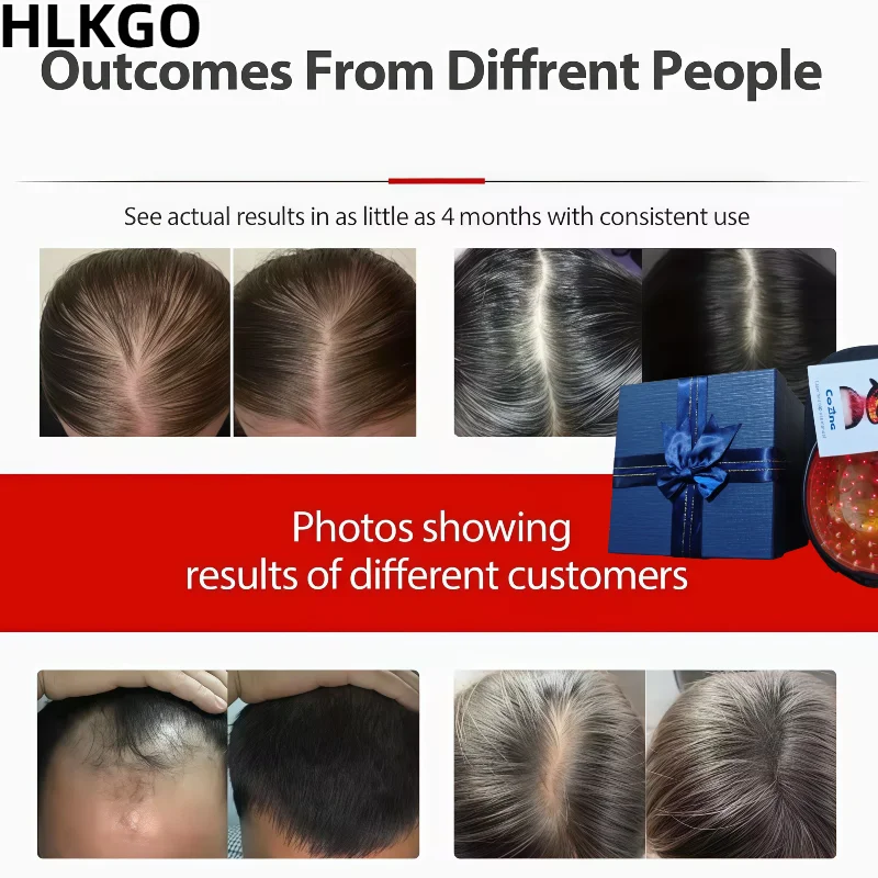 

LLLT Anti Hair Loss Laser Helmet Wireless, Rechargeable Laser Cap for Hair Growth Treatment for Men and Women