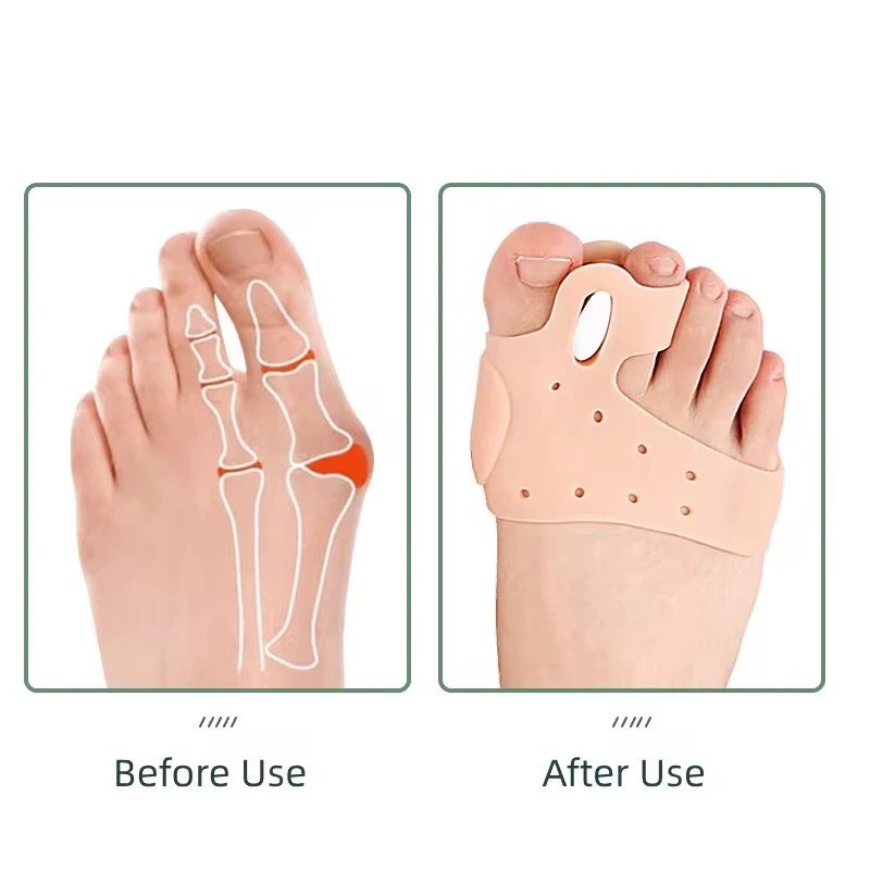 Hallux Valgus Joanete Corrector, Órteses, Ajustador do Polegar, Pedicure, Alisador, Meia, Antepé, Split Pad, Separadores Toe, Hallux, 1 Par