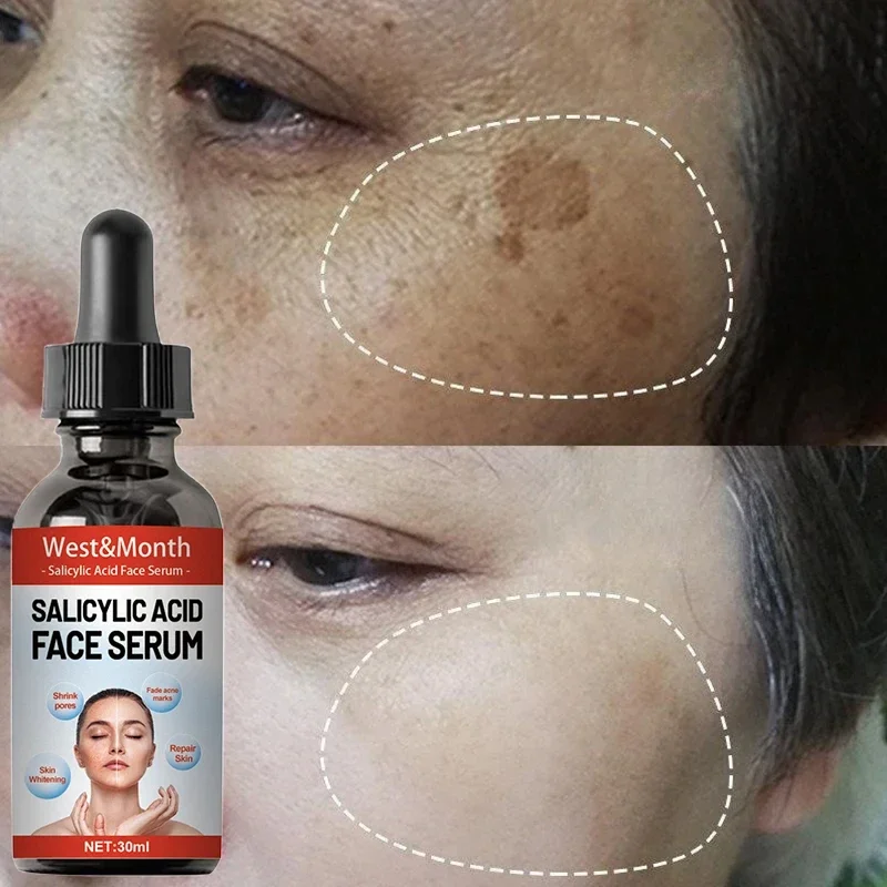 30ml Salicylic Acid Facial Serum Effectively Remove Melasma Lighten Dark Spots Acne Marks And Brighten Skin Tone