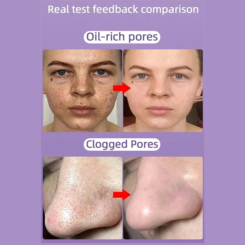 Crema retráctil de poros con ácido salicílico, suero Facial para eliminar cicatrices de acné, estiramiento de cara, piel suave, cuidado de la piel coreana