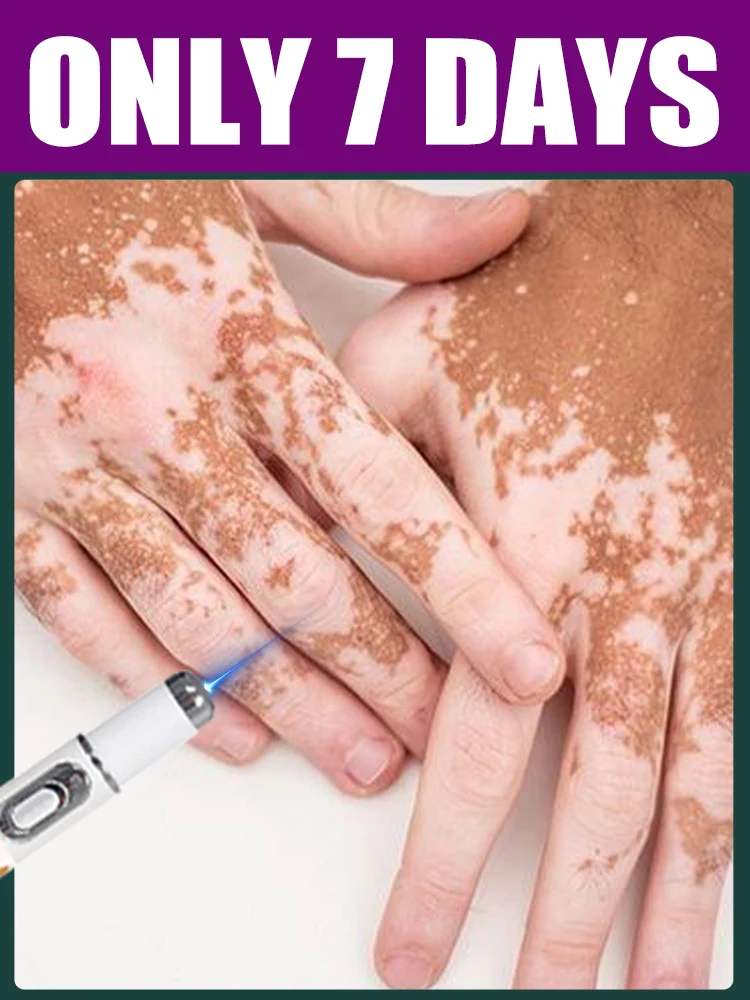 

1nd generation laser hot sale Body care tools， solve Vitiligo