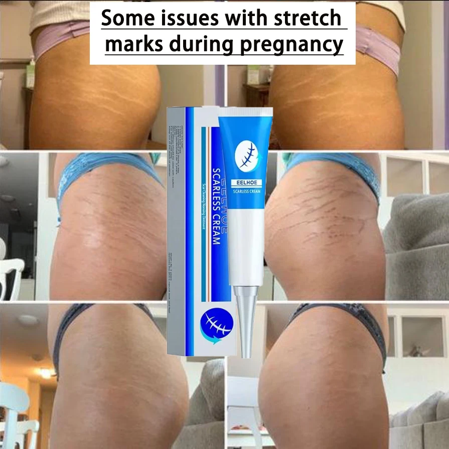 

HOT SALE Stretch Mark Cream Anti-wrinkle Anti-aging Maternal Skin Repair Remove Pregnancy Scar Treatment Body Skin Care