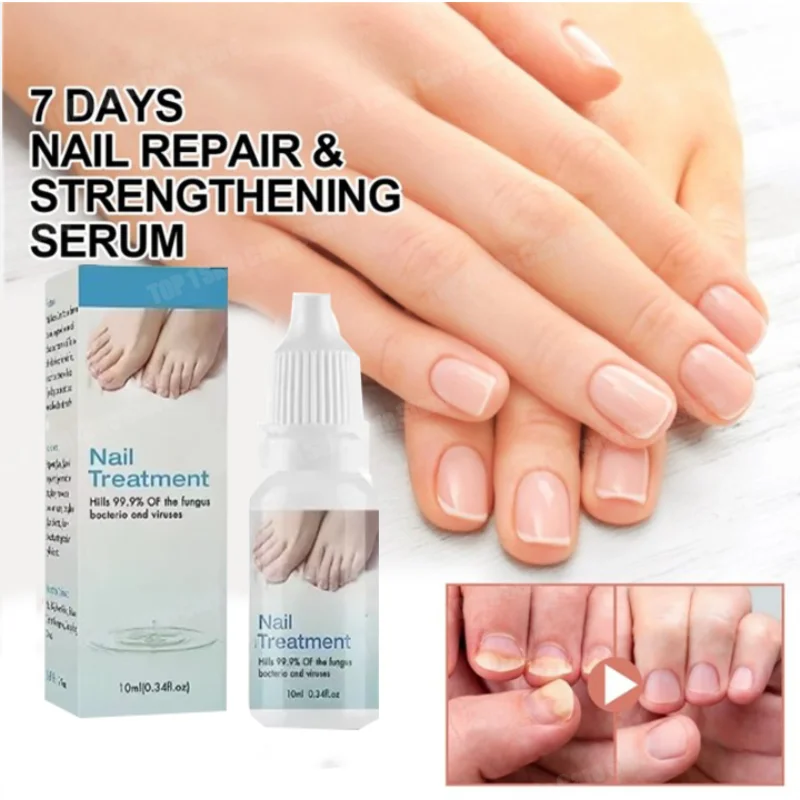 HOT~Nail Fungus Treatment Serum Foot Repair Liquid Toe Nail Fungus Removal Gel Anti Infection Paronychia Onychomycosis oil