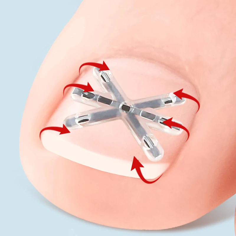 2 Pcs Ingrown Toenail Correction Tool Set with Elastic Patch Sticker Pedicure Tools for Toenail Straightening And Treatment