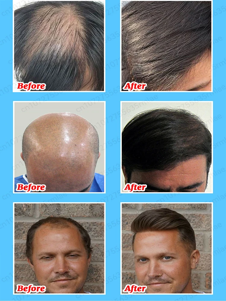 Hair growth oil rapid hair growth effectively repairs baldness hereditary hair loss postpartum hair loss seborrheic alopecia