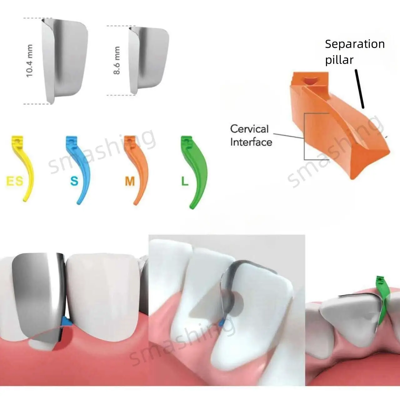 200 unids/caja sistema de matriz Dental Anterior bandas de matriz de cuña cuñas interdentales suministros de odontología materiales bucales