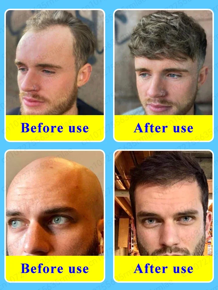 Prevent baldness, effectively repair hair loss, and regenerate hair