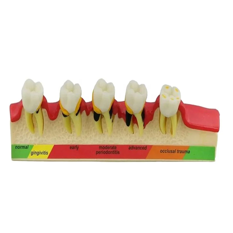 New Product Den tal Periodontal Disease Classification Teaching Model M4010