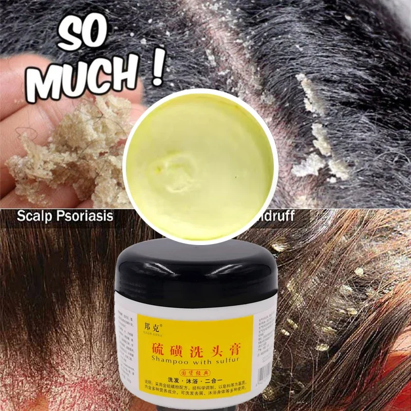 

250g Sulfur Shampoo To Remove Lice Mites Dandruff Itching Oil Control Deep Cleaning Damage Repair Strong And PreventHairBreakage