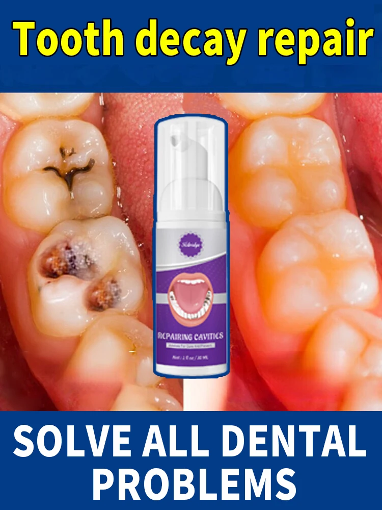 decay Tooth Repair Repairing Cavities Protect Anti caries