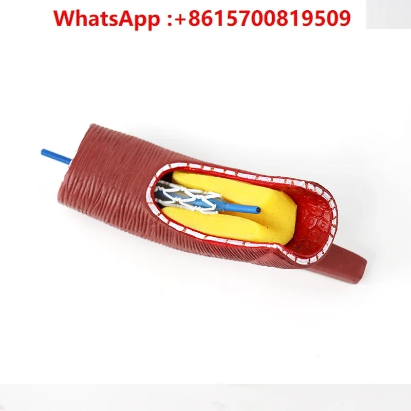 blood vessel blocking stent enlargement model Cardiac stent Coronary artery stent model