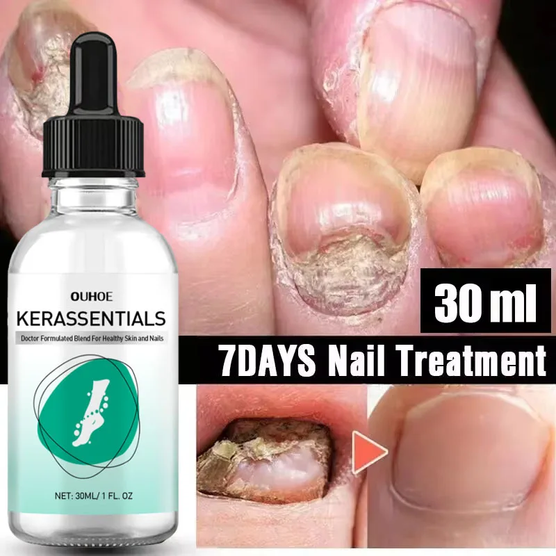 7 giorni Nail fungino Treatment Serum Foot Toe Nail Fungus Removal olio essenziale Anti infezione onicomicosi paronichia Repair Gel