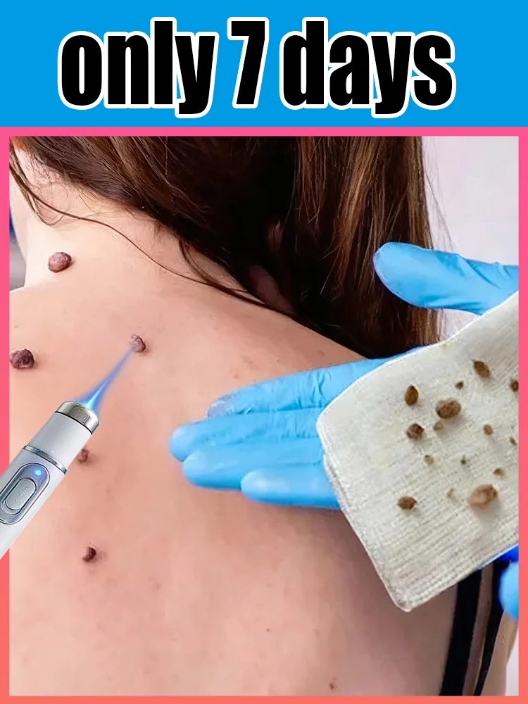 第三世代レーザーペン：いぼがすぐに落ちる